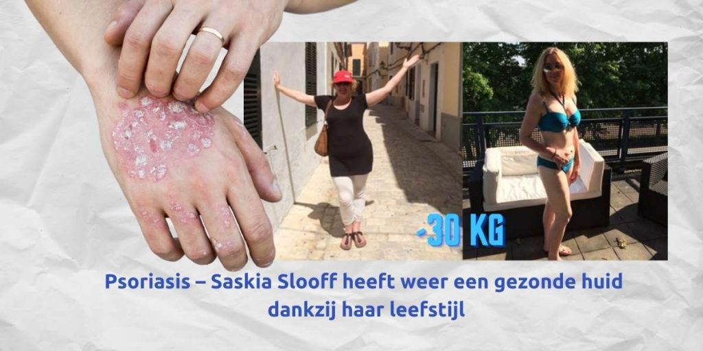 Psoriasis – Saskia Slooff heeft weer een gezonde huid dankzij haar leefstijl